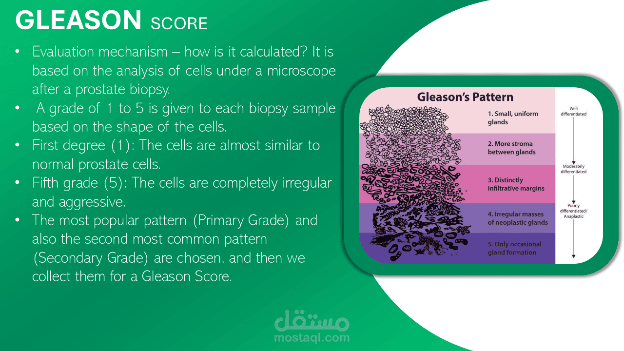 GLEASON SCORING SYSTEM Of Prostatic Cancer | مستقل