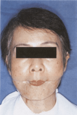 بديل وجهي فكيّ كبير لشذوذ فكي سفلي كامل: تقرير عن حالة سريرية