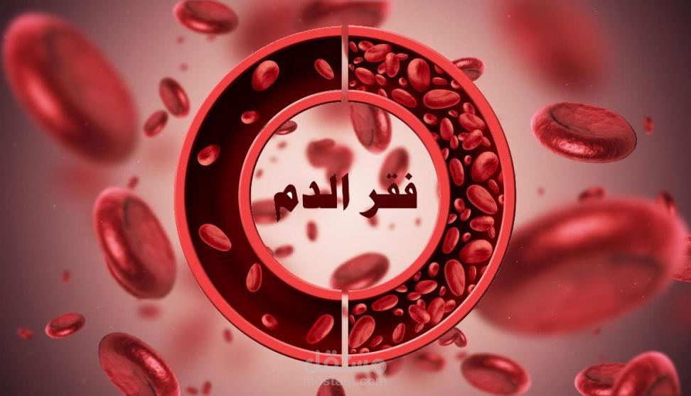 فقر الدم المنجلي، (الانيميا المنجلية).