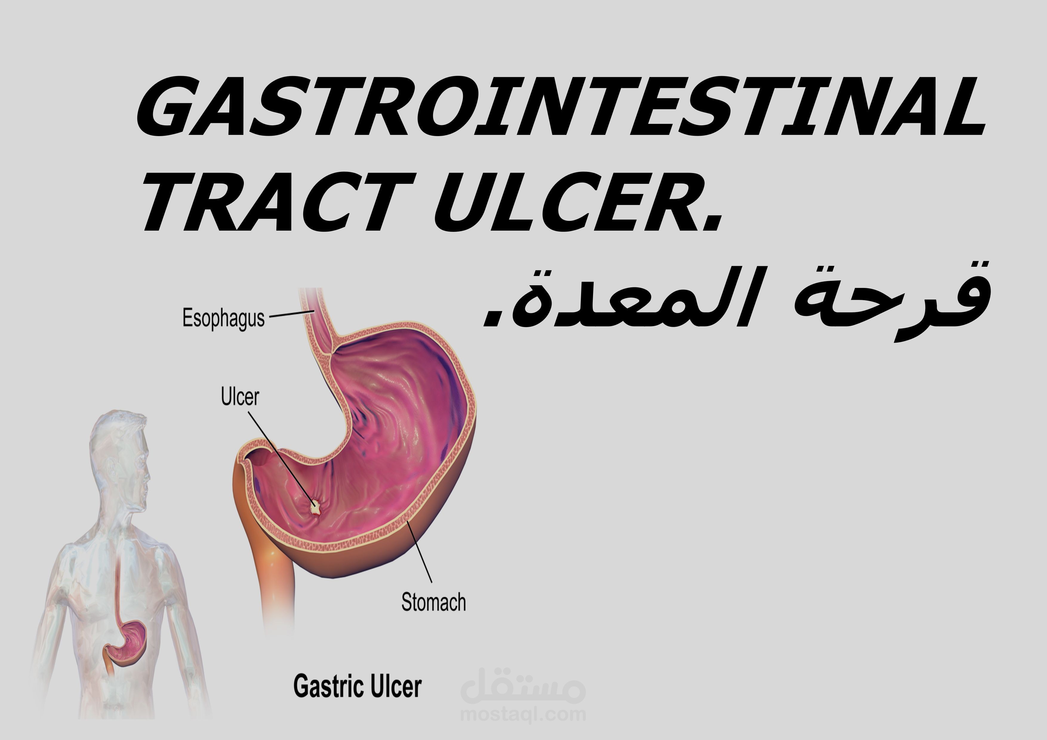 gastrointestinal tract ulcer