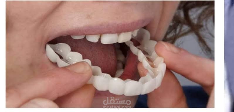 فينير الاسنان المتحرك