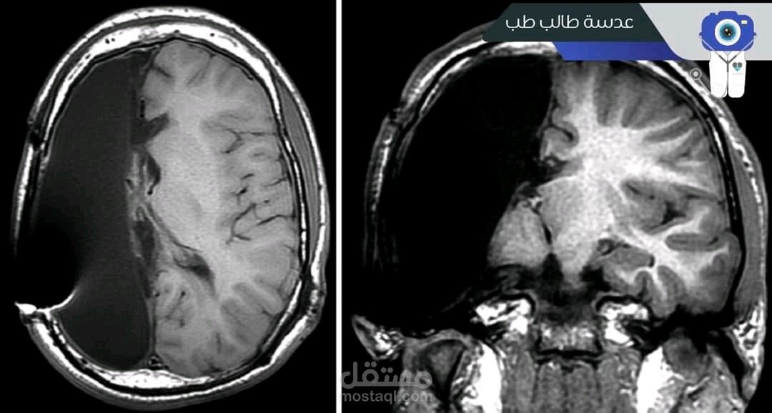 هل يستطيع الإنسان العيش بنصف دماغ؟