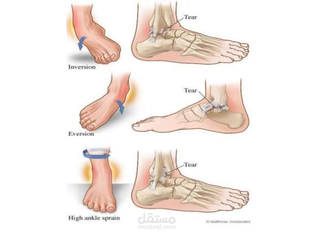 عرض تقديمي  التواء الكاحل
