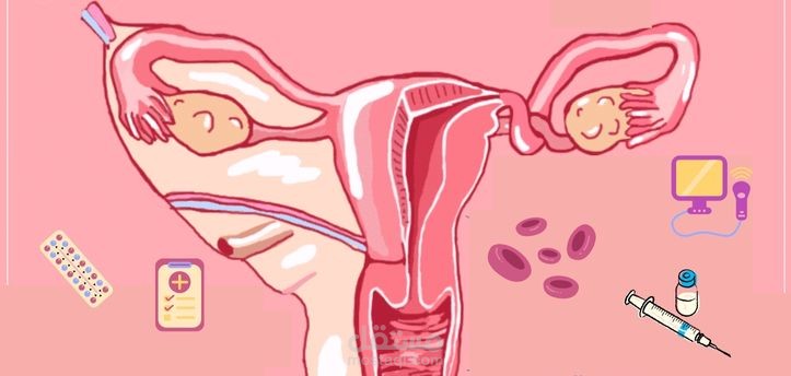 التواء المبيض (Ovarian Torsion )
