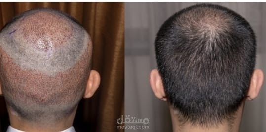 تكلفة زراعة الشعر في الرياض