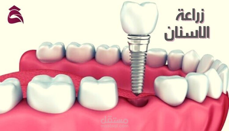 مقال عن: زراعة الاسنان