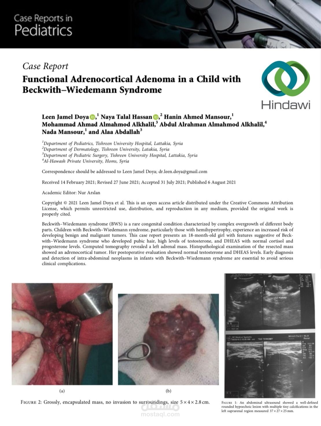 بحث علمي: متلازمة بيكويث ويدمان