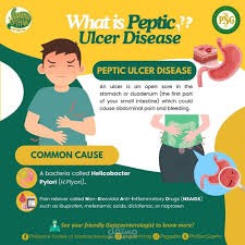 peptic ulcer (قرحة المعدة)