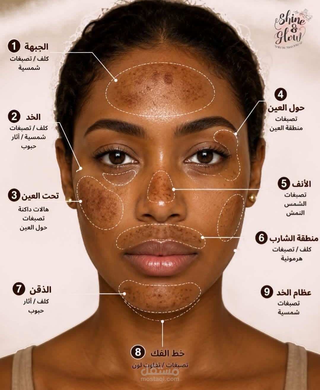 علاج التصبغات والبقع الداكنة – حالة حقيقية