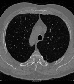 Lung Cancer Detection