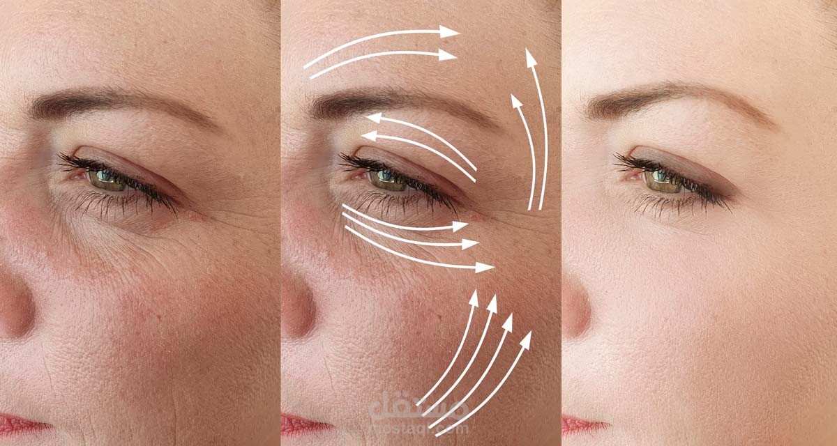 مقال عن شد الوجه بالخيوط في مجال التجميل