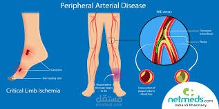 Peripheral artery disease