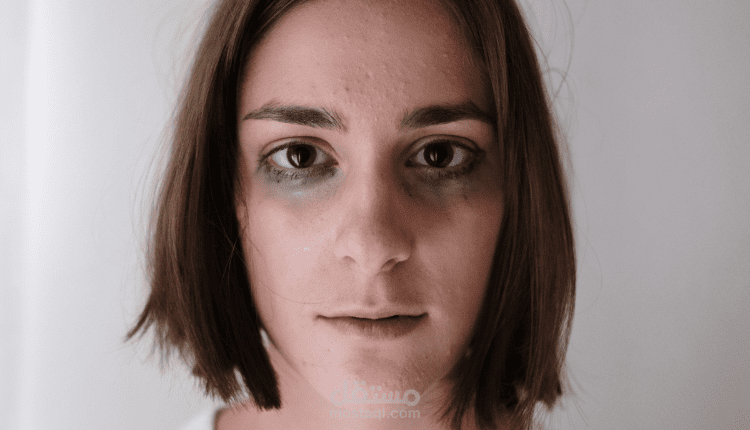 كتابة مقال عن: الهوس الخفيف؛ أبرز الأعراض، الأسباب، التشخيص، وآلية العلاج