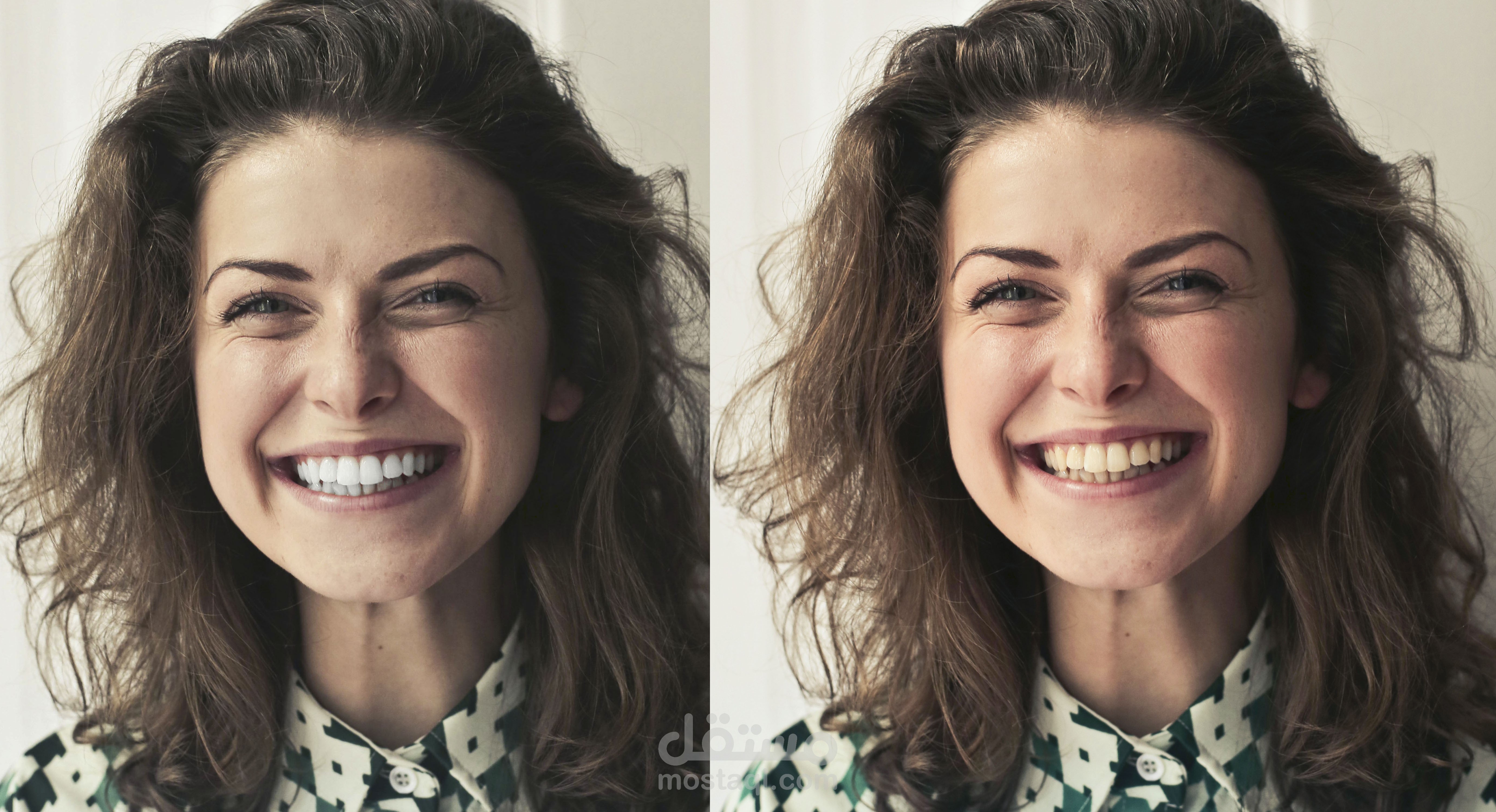 تبييض الاسنان