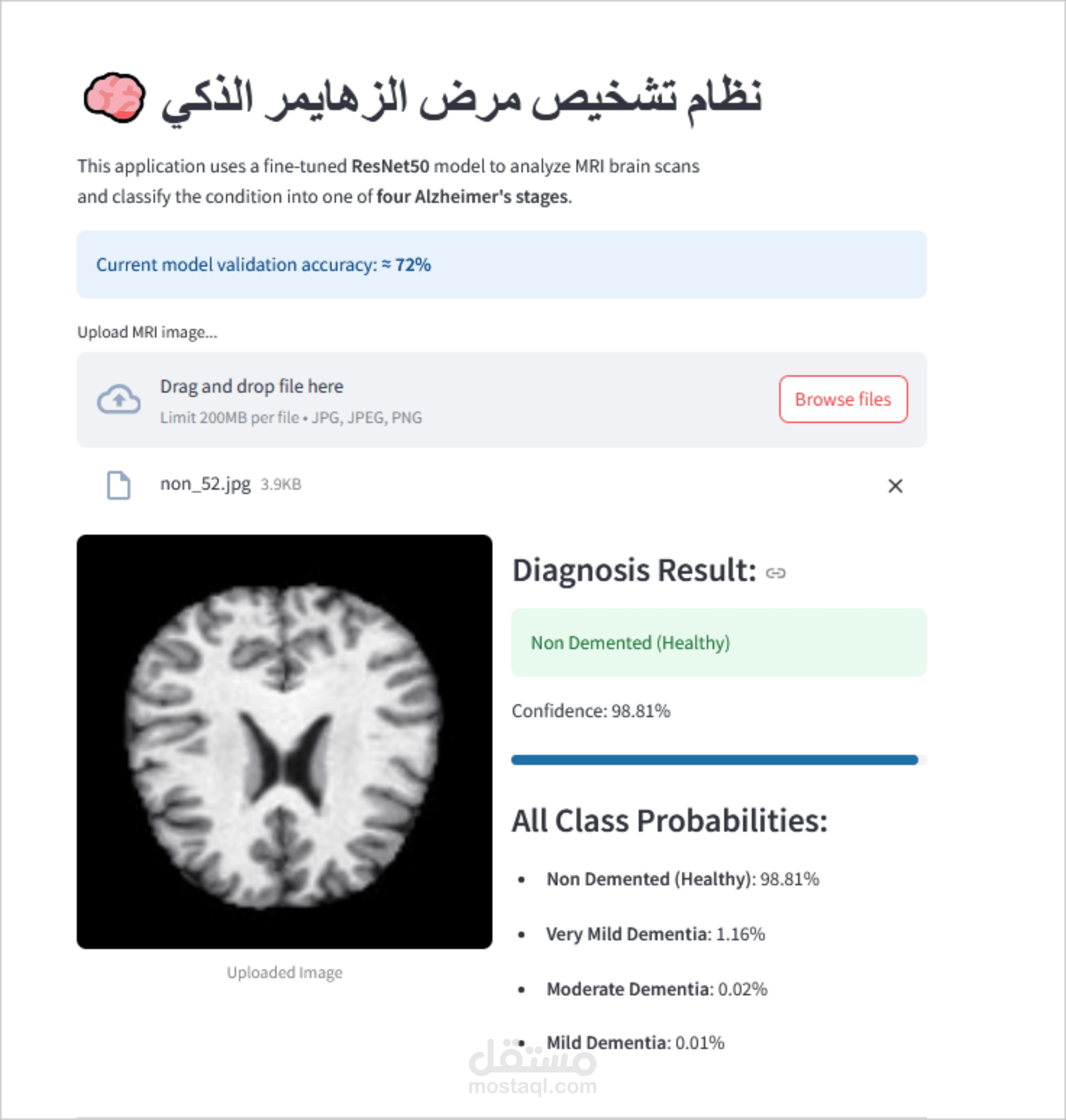 مودل ذكاء اصطناعي لاكتشاف مرض الزهايمر