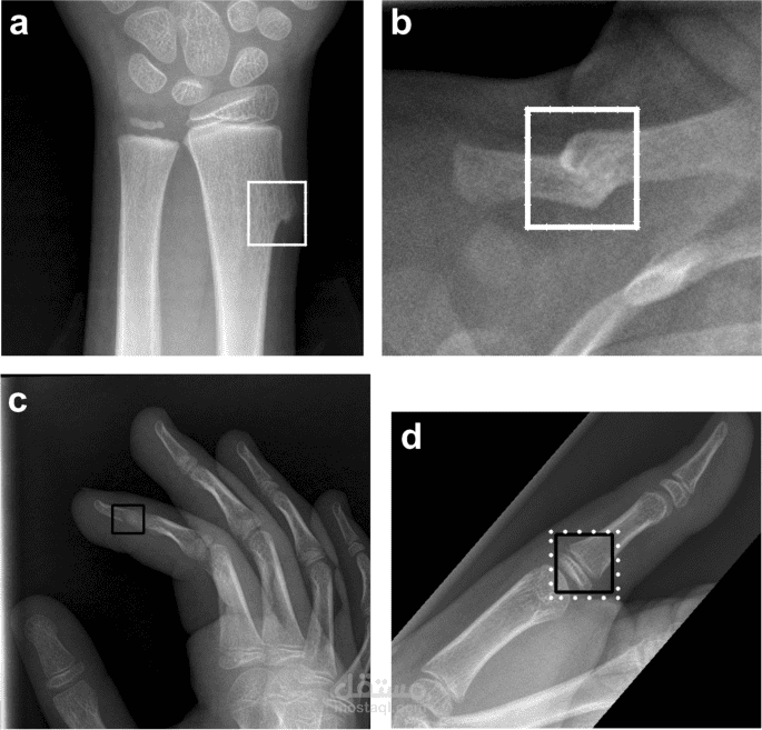 تطوير نظام تشخيص الكسور في صور الأشعة السينية بتعلم الآلة