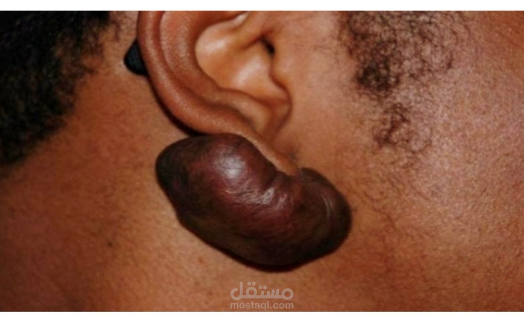 ندوب الجدرة؛ العوامل التي تزيد من خطر الإصابة والأساليب العلاجية