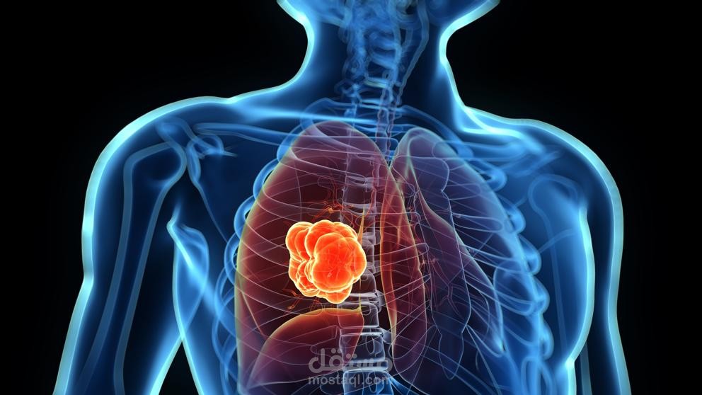 بحث عن سرطان الرئة "طرق التشخيص و النتائج المتوقعة"