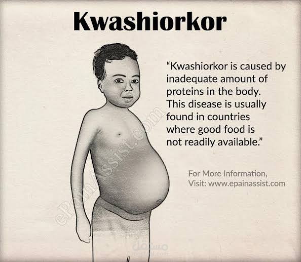 شرح محاضرة اطفال عن ال kwashiorkor