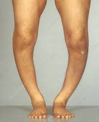 شرح محاضرة اطفال عن ال Rickets