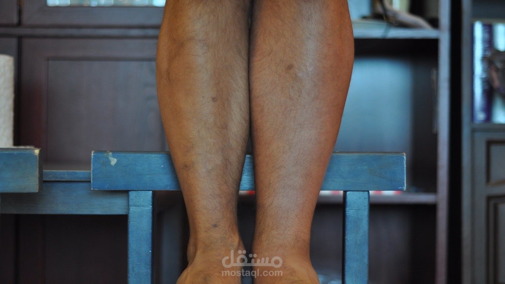 اعراض جلطة الرجلين والفرق بينها وبين ألم الساق