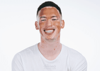مقال عن مرض البهاق Vitiligo Disease