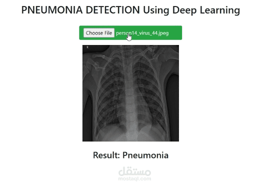 Pneumonia Detection