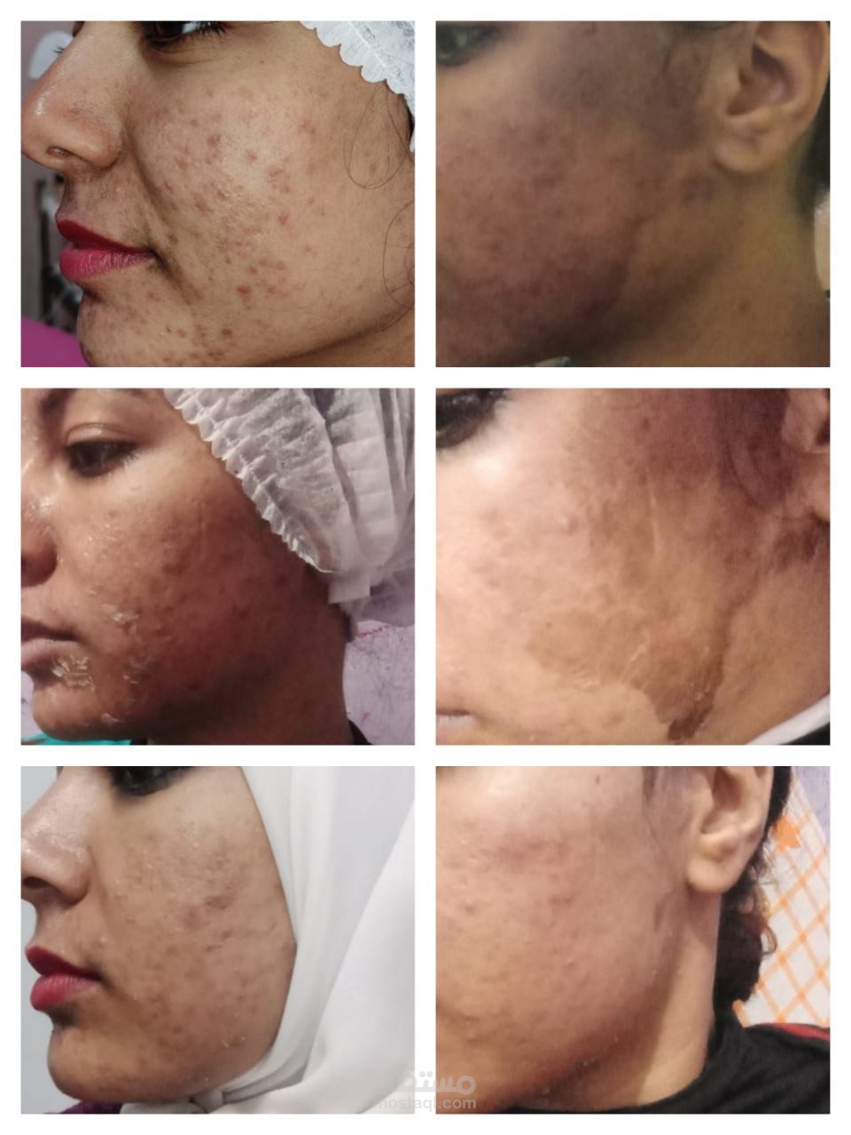 عمل تعديل علي الصور لجلسة تقشير لمركز تجميل