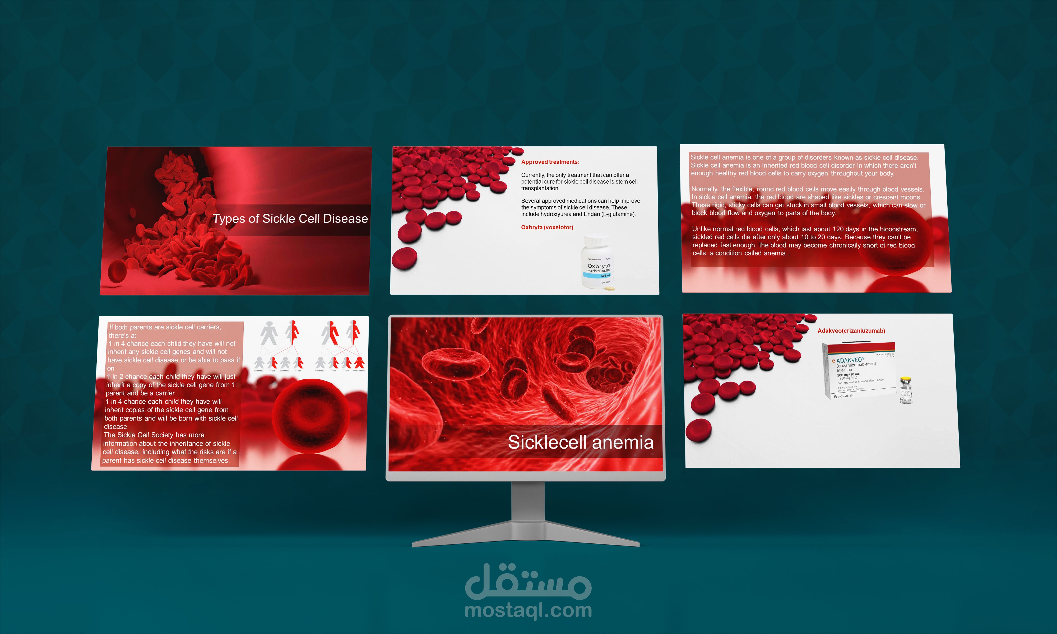 عرض تقديمي عن مرض فقر الدم المنجلي (sickle cell anemia)