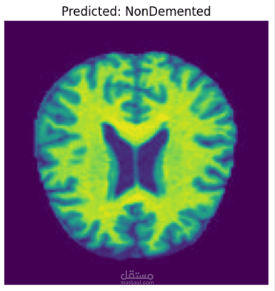 Alzheimer MRI Detection — اكتشاف مراحل الزهايمر من صور MRI