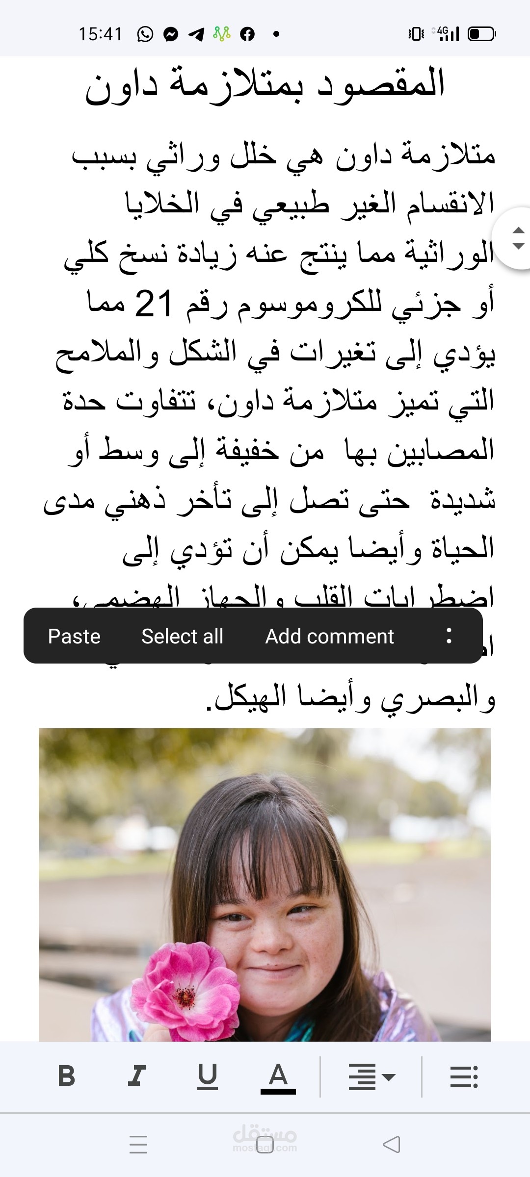 المقصود بمتلازمة داون