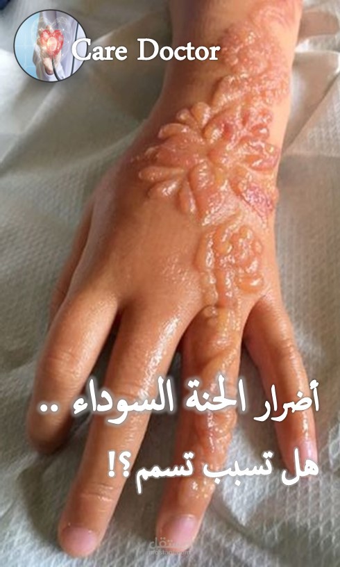 أضرار الحنة السوداء.. هل تسبب تسمم؟