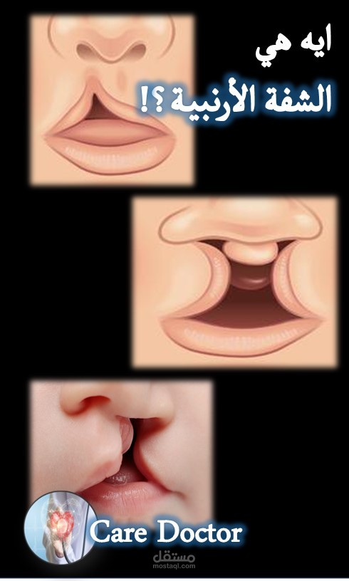 ايه هي الشفة الأرنبية؟ وما أسبابها ؟