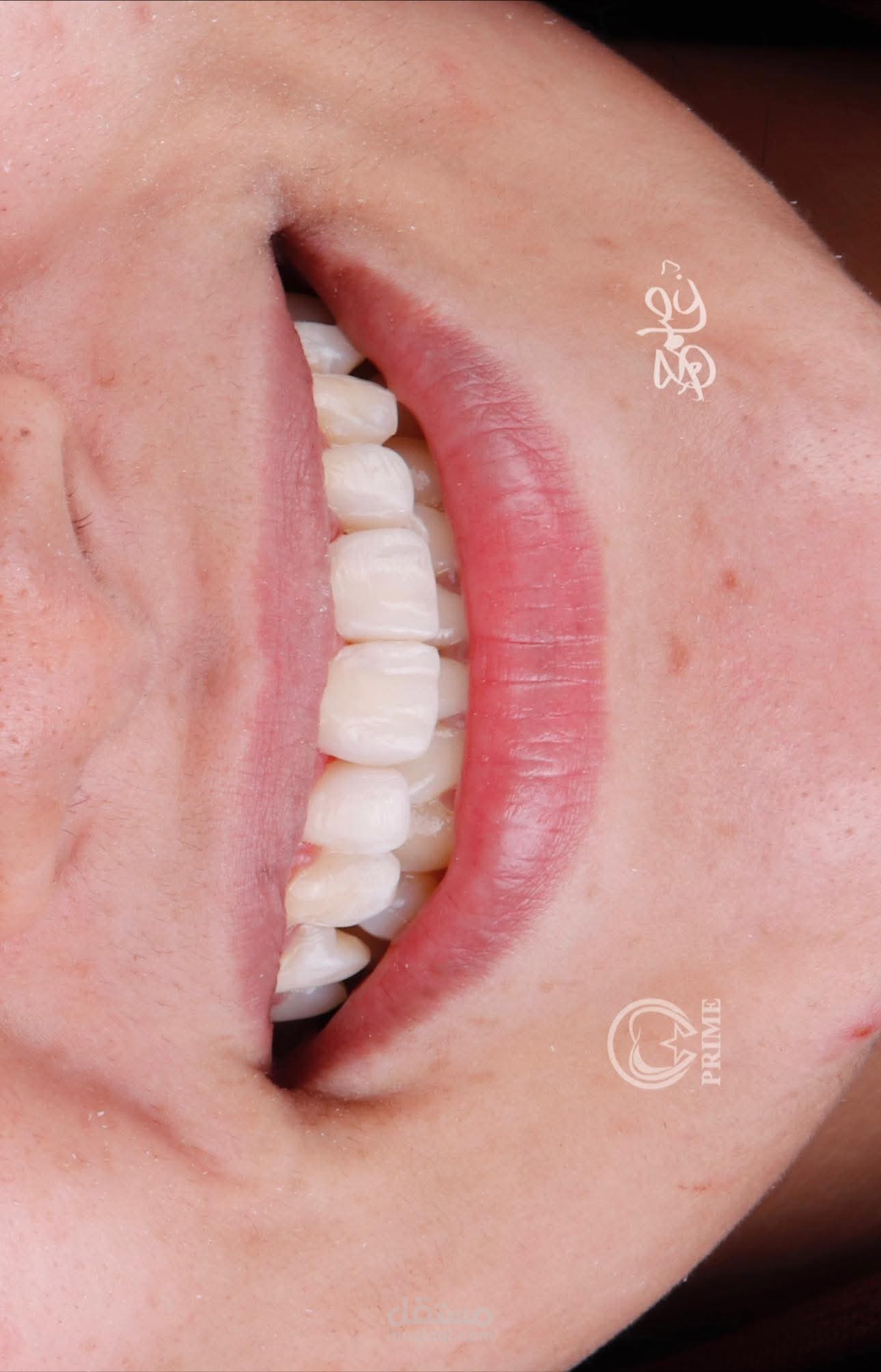 كتابة محتوى تسويقي لعيادة تجميل أسنان - اللعب على "وتر الثقة" وتحويل التردد لقرار.