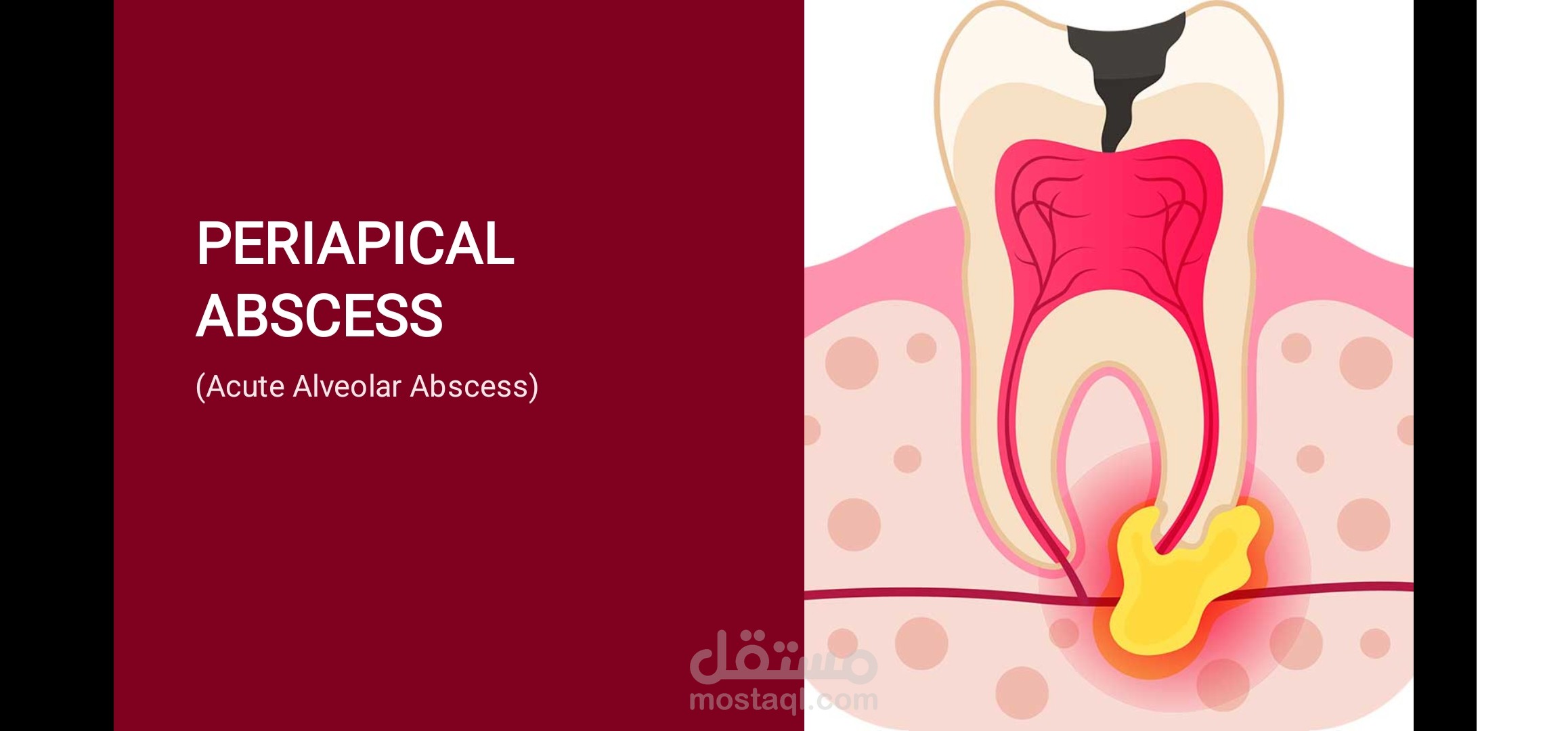 عرض تقديمي طبي وأكاديمي شامل: الخراج حول الذروي (Periapical Abscess)