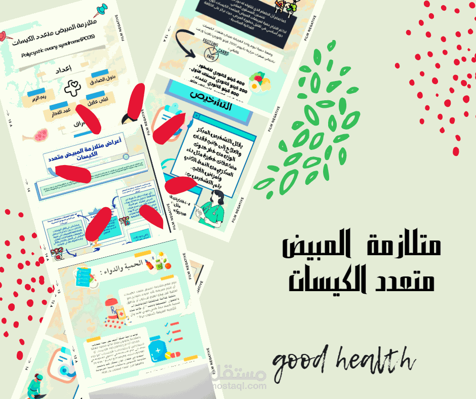 عمل طبي متلازمة المبيض متعدد الكيسات