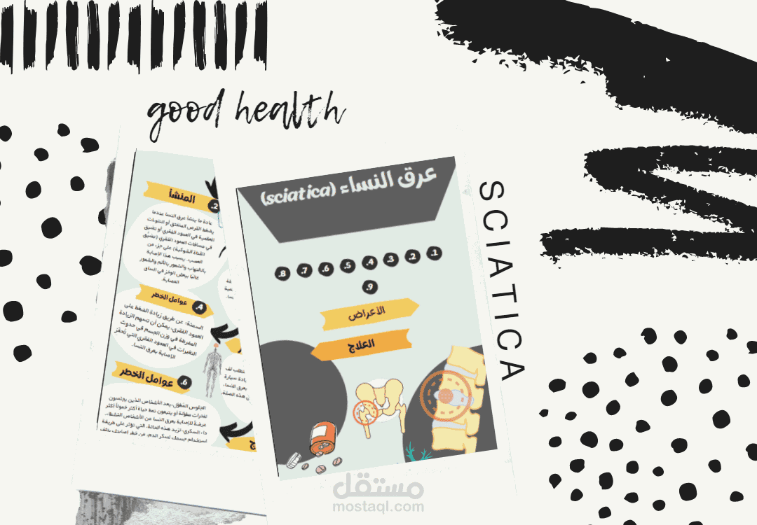 عمل طبي عرق النسا