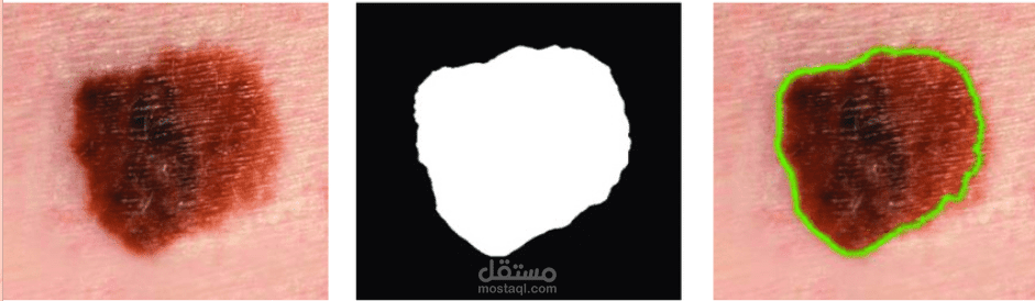 DermaTection تشخيص وتحديد امراض الجلدية بالذكاء الاصطناعي