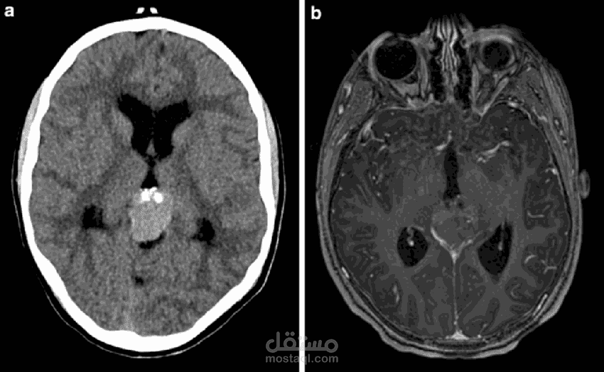 Brain Cancer Prediction