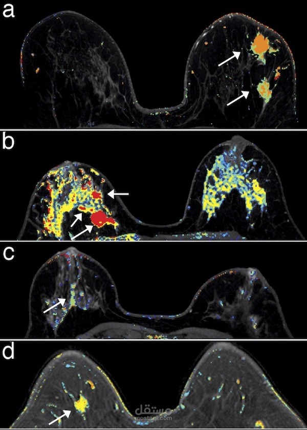 Breast Cancer Prediction
