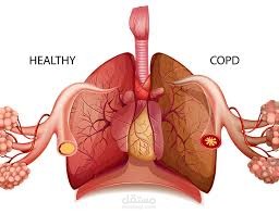 COPD ( Chronic obstructive pulmonary disease )