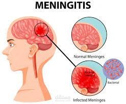 Meningitis