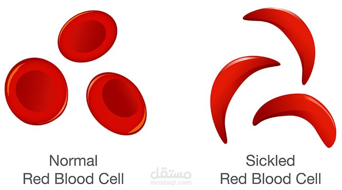 sickle cell anemia
