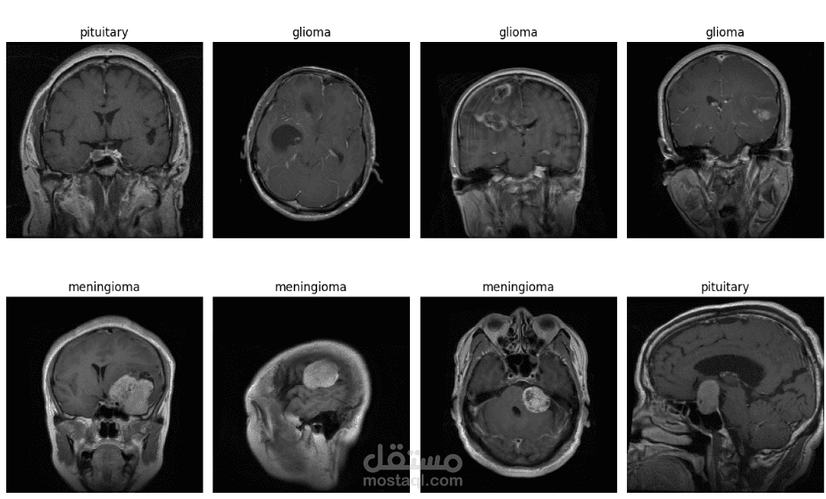 تصنيف أورام الدماغ من صور الرنين المغناطيسي (MRI) باستخدام الشبكات العصبية التلافيفية (CNN)
