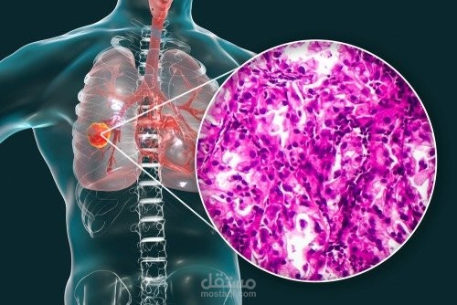 Lung cancer Classification