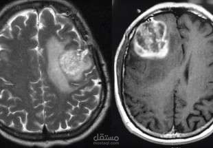 التعرف اللألي على الأشخاص المصابين بمرض سرطان الدماغ