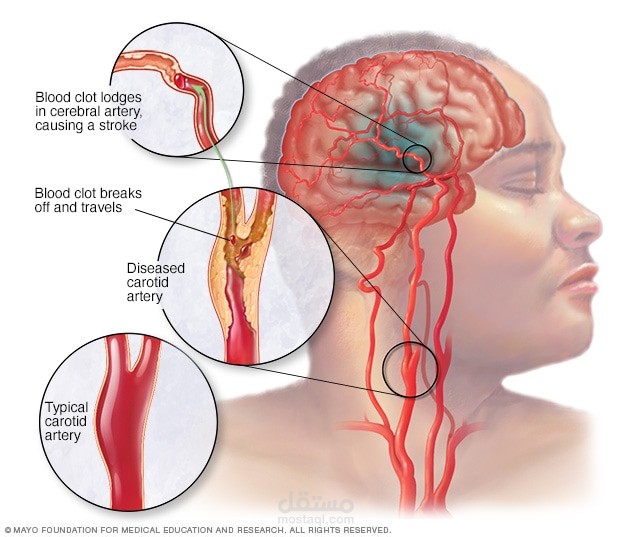 رعاية مرضى السكتة الدماغية
