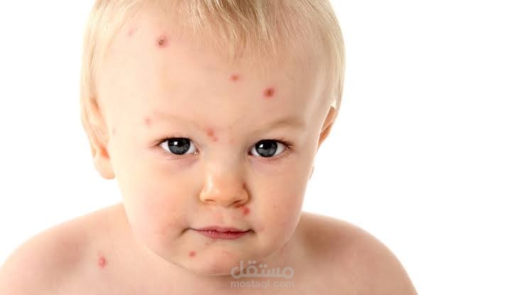 Chickenpox in children