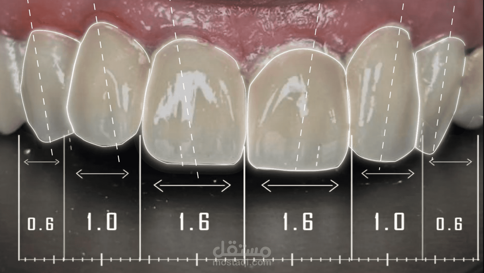 تركيب طقم أسنان لدكتور أحمد السيد
