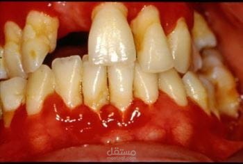 https://youssiffath.blogspot.com/2023/09/gum-disease-and-diabetes.html